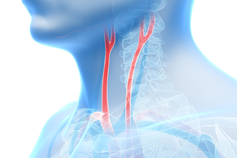 Carotid Approach Now Offered for TAVR