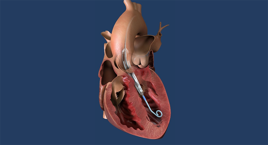 clinical-trial-for-worlds-smallest-heart-pump.png